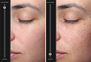 VISIA Skin Imaging