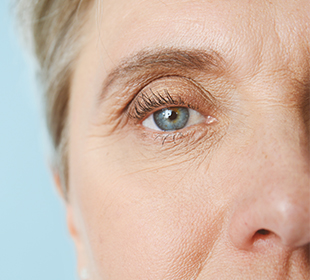 Droopy Eyelids Ptosis