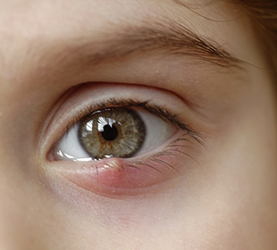 Stye Chalazion