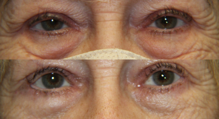 Eyelid Lesion