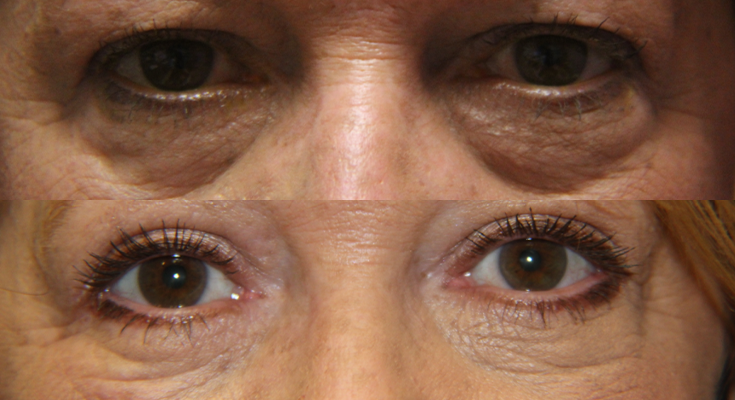 Eyelid Lesion