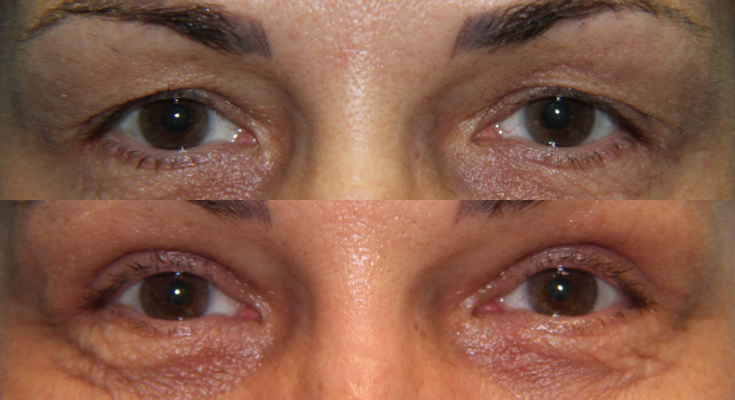 Eyelid Lesion