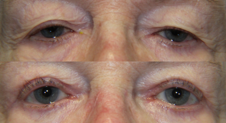 Eyelid Lesion