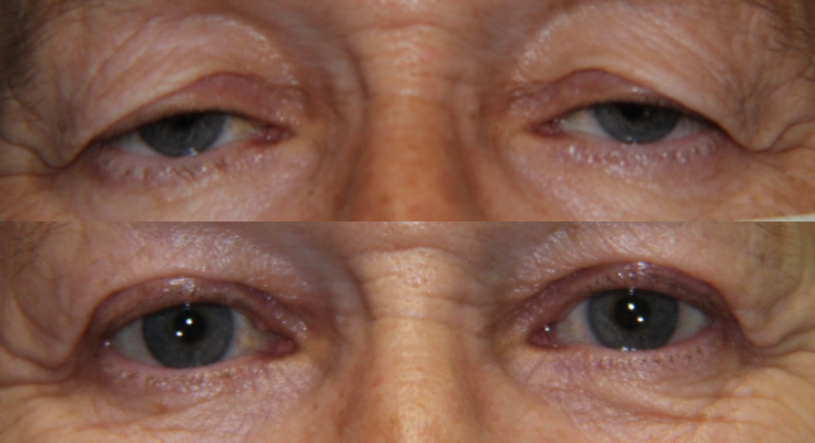 Eyelid Lesion