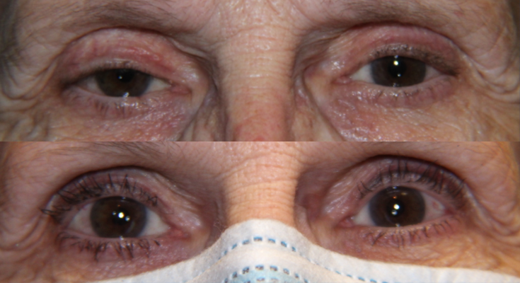 Eyelid Lesion