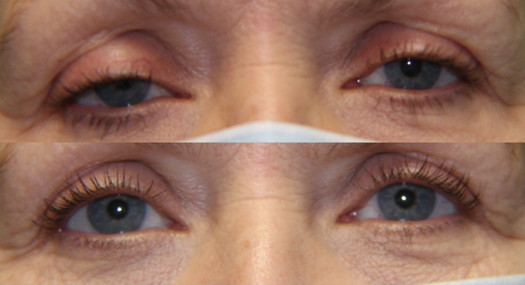 Eyelid Lesion
