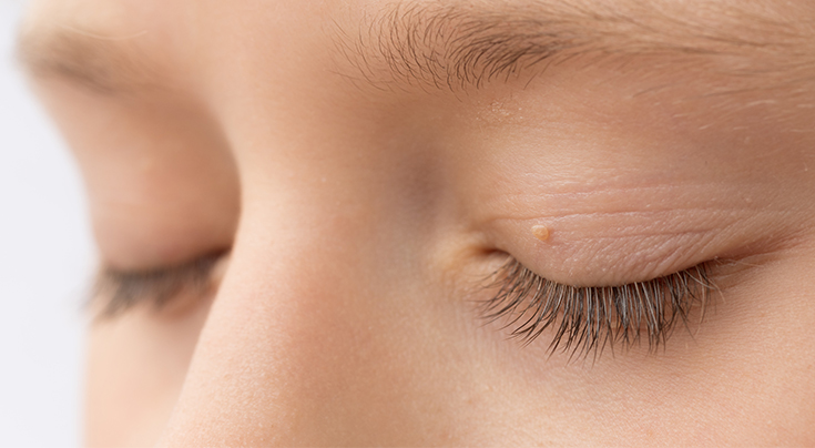 Eyelid Skin Cancer