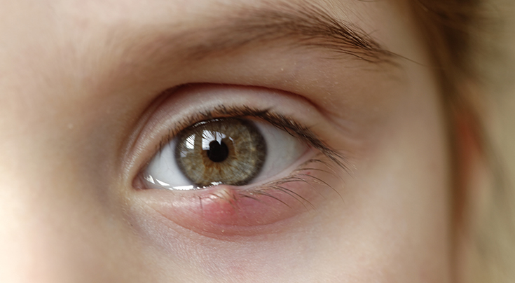 Stye Chalazion